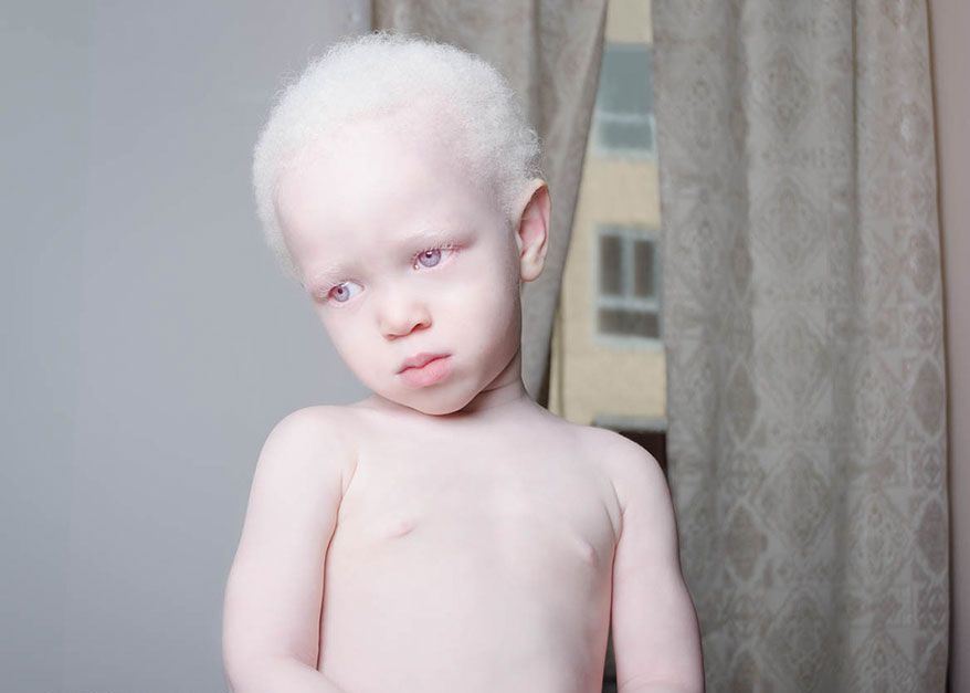 ребенок альбинос фото